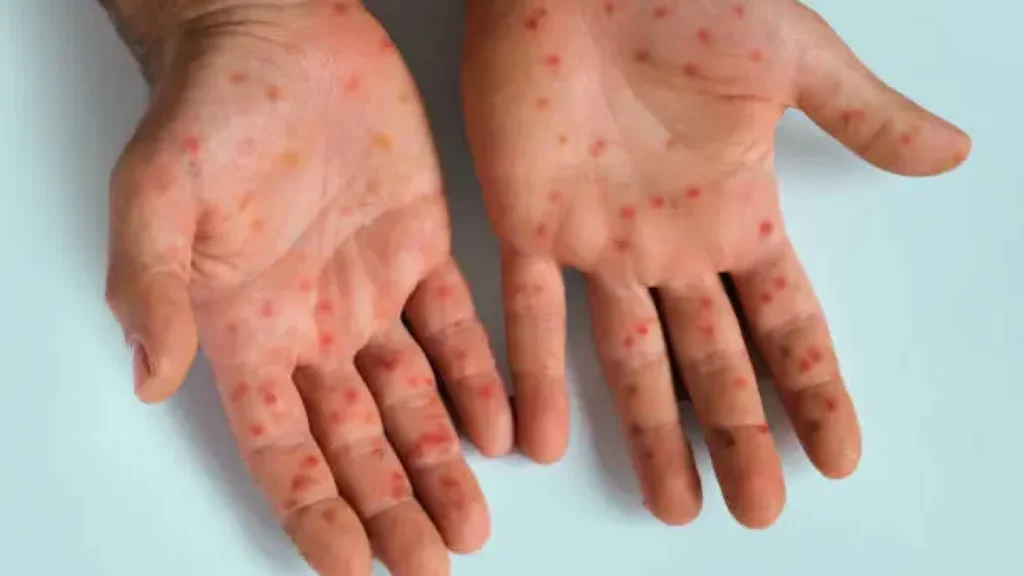 WHO Tetapkan Mpox Sebagai Darurat Kesehatan Global, Lonjakan Kasus Terjadi di Indonesia