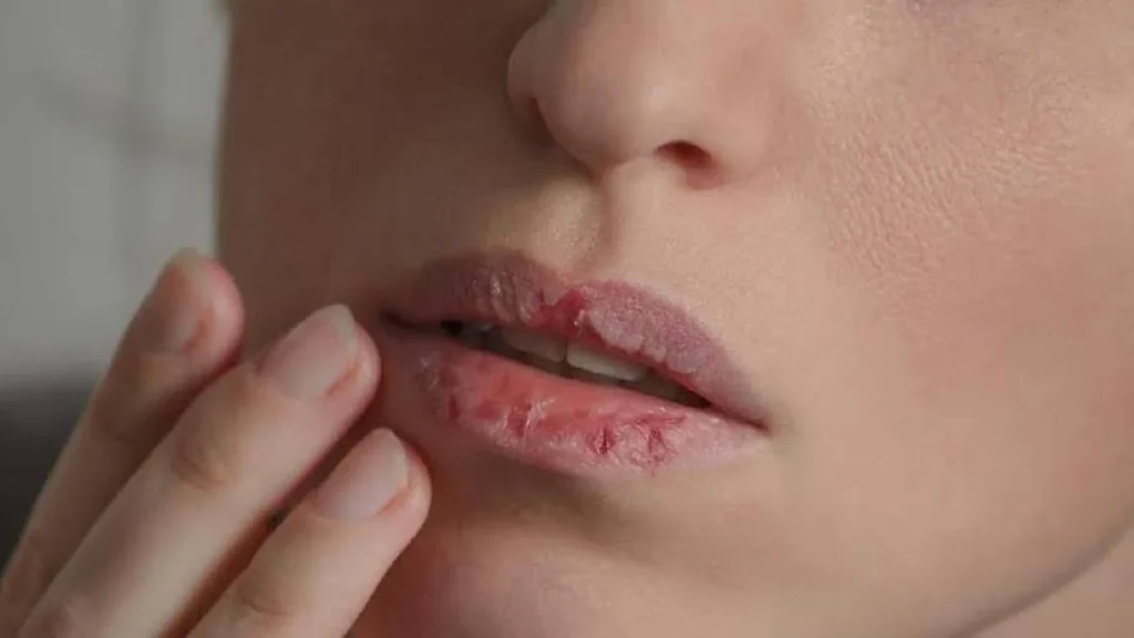 Cara Efektif Merawat Bibir Kering agar Tetap Sehat dan Terhidrasi